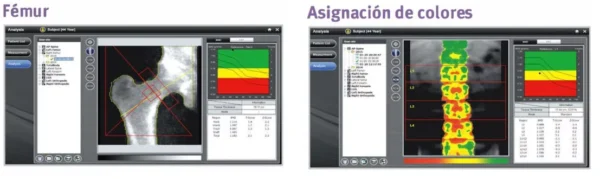 Sistema de densitometría ósea DXA PRIMUS Osteosys - Image 3